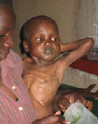 Malnourished child